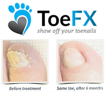 toefx before and after