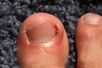 Ingrown Toenails and Infection Control