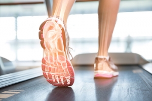 Causes of Overpronation