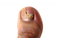 The Early Stages of Toenail Fungus