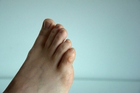 How to Get Rid of Corns on Your Feet