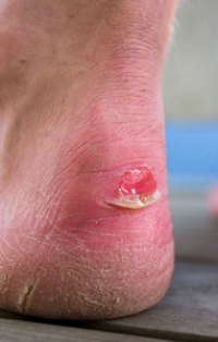 Soccer Players And Blisters