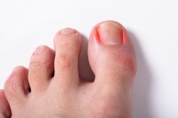 Do Not Ignore Ingrown Toenails