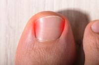 Possible Reasons an Ingrown Toenail Can Develop