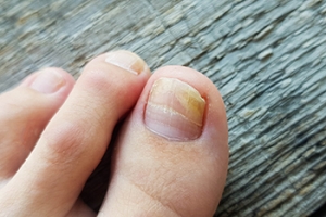 Remedies for Toenail Fungus