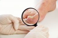 Signs You May Have Toenail Fungus