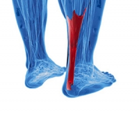Who Is at Risk for Getting an Achilles Tendon Rupture?