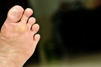 Treating Plantar Warts