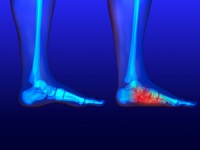 Causes of Flat Feet