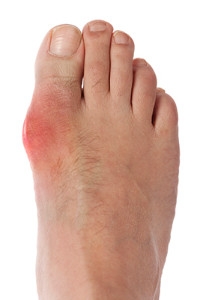 Lifestyle Changes and Gout