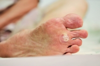 Why Do Plantar Warts Grow Inward?