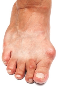 Are Bunions Painful?