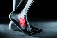 Running and Stress Fractures