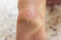 Why Heels Crack and How to Find Relief