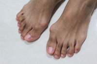 Bunion Complications