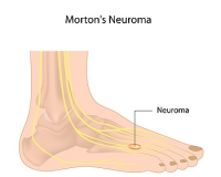 Do I Have Morton's Neuroma?