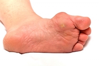 Bunions May Lead to Additional Foot Conditions