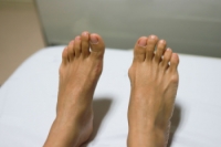 The Relationship Between Arthritis and Bunions